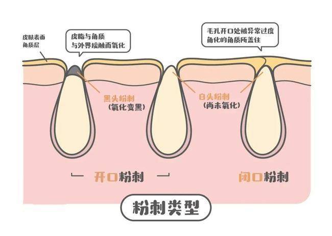 去闭口快速有效的方法,去闭口最有效的方法推荐