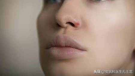 皮肤科常见疾病:嘴唇上火的真相——单纯疱疹