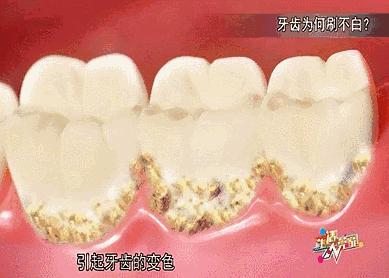 一张嘴就闻到牙臭味怎么办,一张嘴就恶臭怎么回事