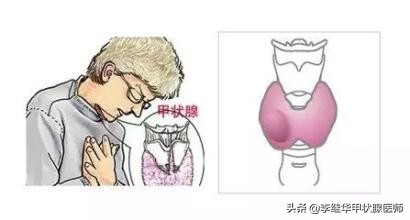 砂粒样钙化是什么意思,钙化结节和肿瘤结节区别