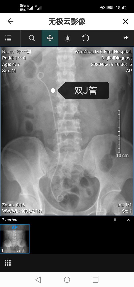 刷新了对疼痛的认知～我的肾结石手术经历