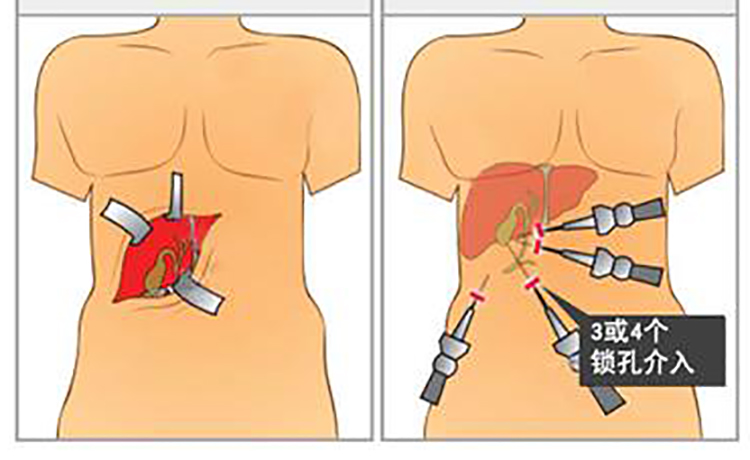 胆结石做了二次开腹还能做微创不,胆结石微创手术与传统手术对比