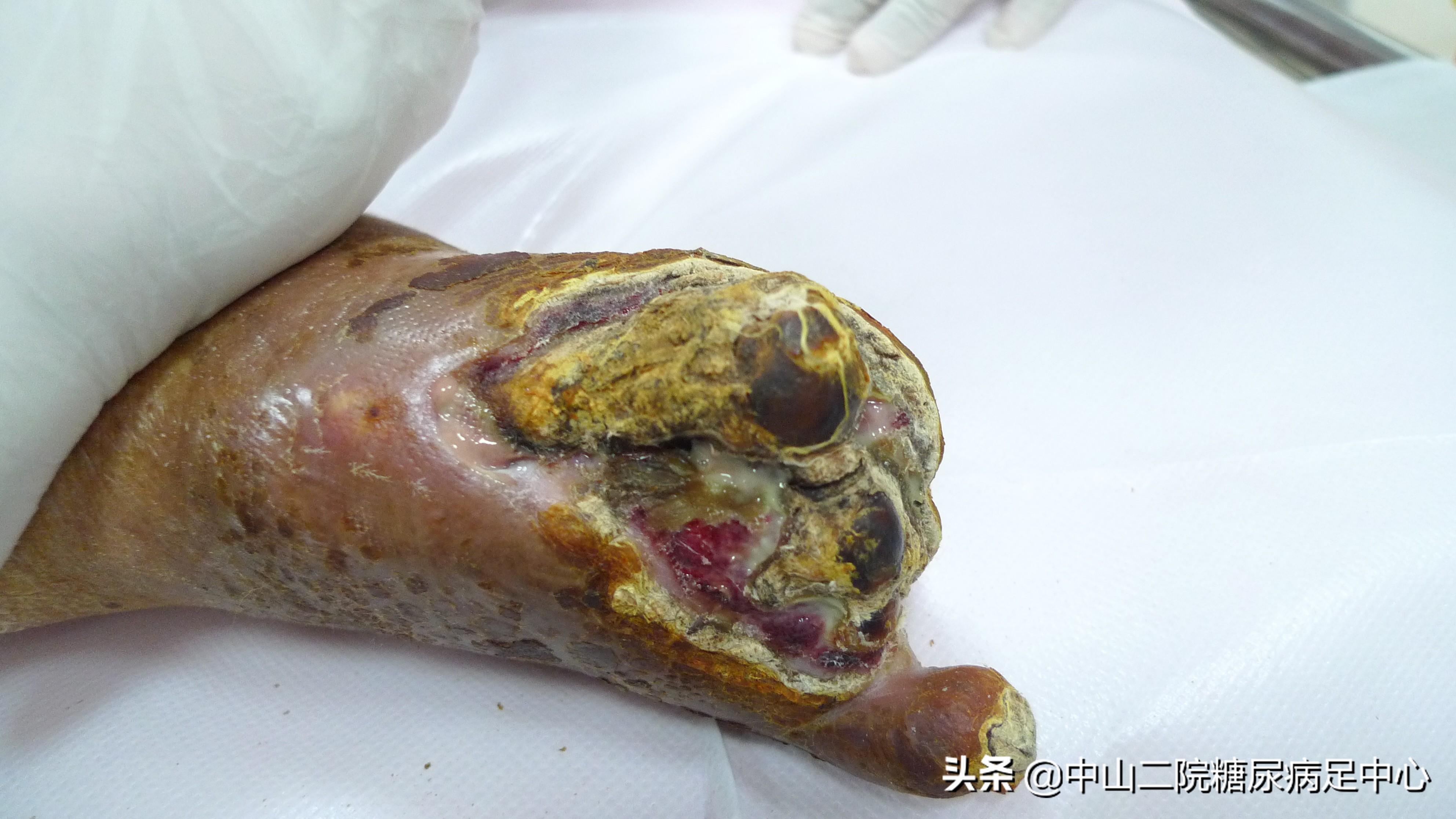 糖尿病足在介入科怎么治疗,糖尿病足疼痛的介入治疗