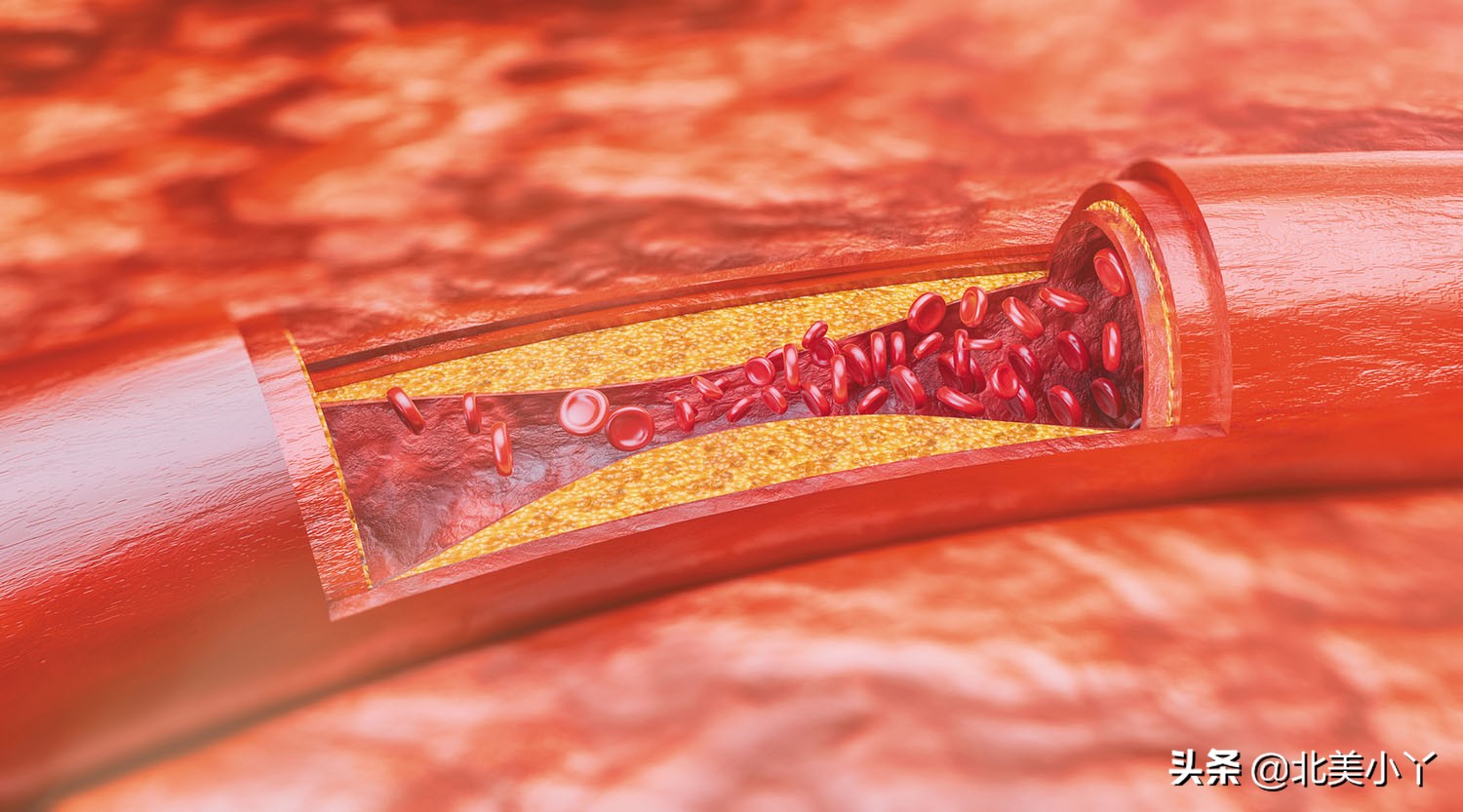 盐酸小檗碱能治疗三高吗,盐酸小檗碱降血脂主要作用