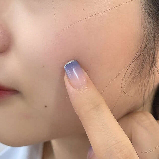 面部毛孔粗大如何改善,面部毛孔粗大怎么办如何改善