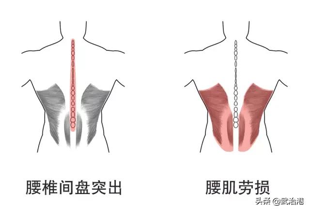 腰椎间盘突出颈椎康复操视频,腰椎间盘突出手术后多久康复