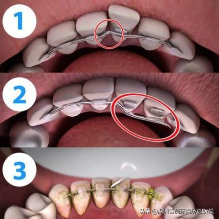 保持器怎么做微调,保持器该怎么选
