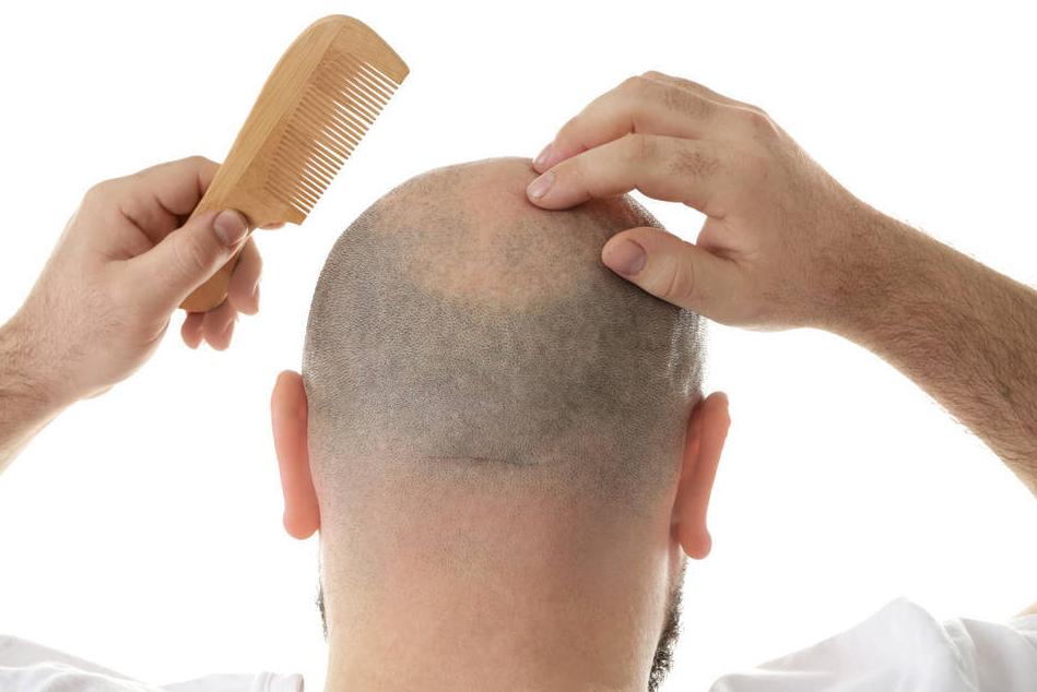 脱发掉发严重一个方法解决烦恼,迅速脱发一般是什么类型的脱发