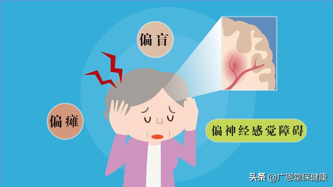 预防脑梗塞的小妙招,防止脑梗塞的最好方法