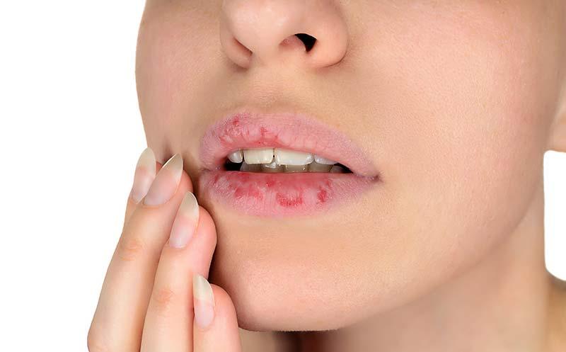 嘴唇起皮了为什么不能撕,反反复复嘴唇干裂起皮还痒怎么办