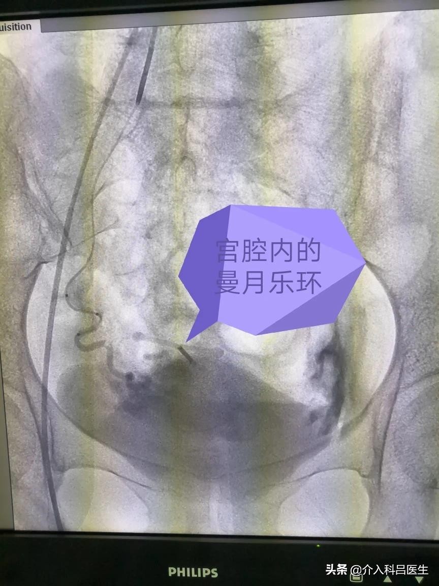 少量出血微创手术,得什么病会失血过多需要微创手术