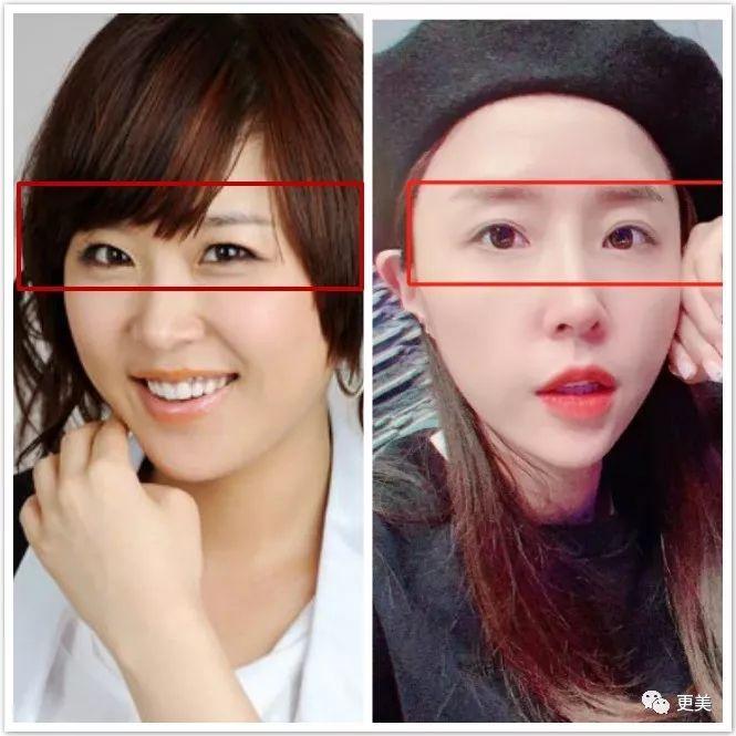 天后因队友吸du人气暴跌，公开承认整形却成蛇精下巴，瘦到脱相