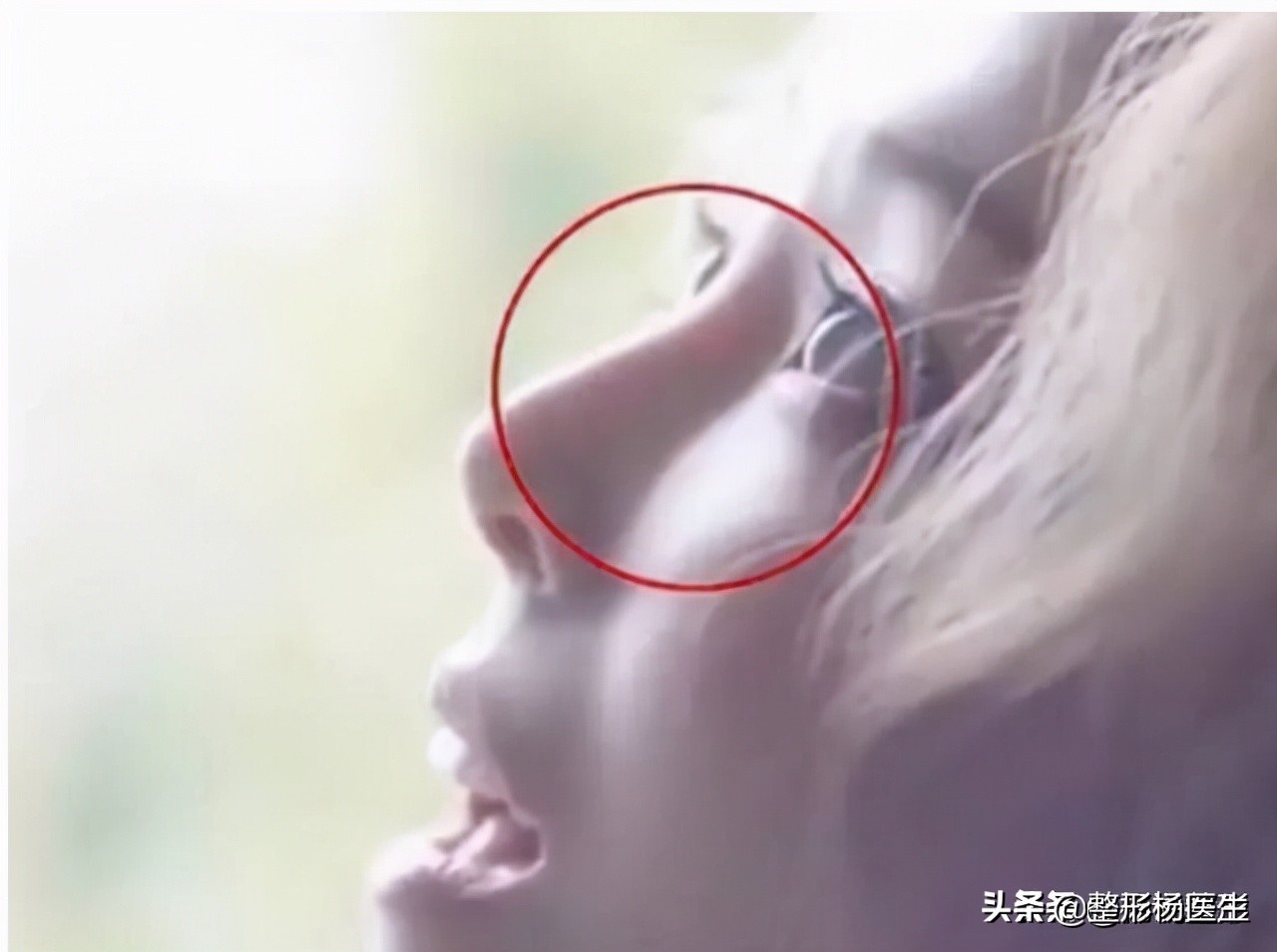 隆鼻失败的常见原因有哪些,隆鼻失败最快的解决方法