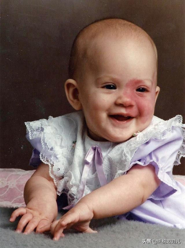 怎么避免宝宝出生有胎记,出生宝宝有胎记是孕期怎么导致的