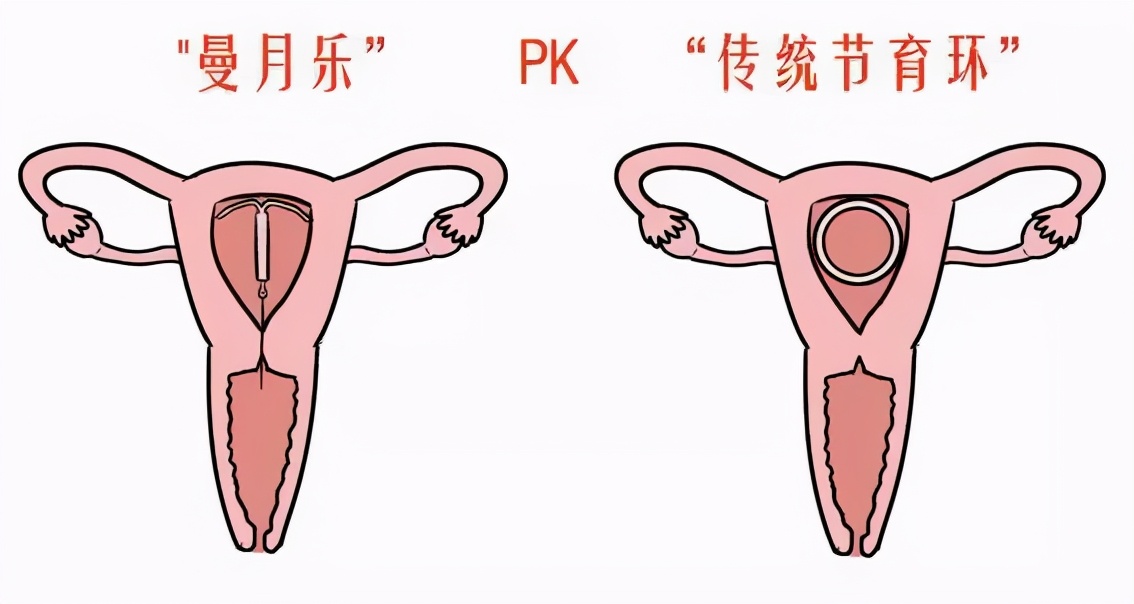 这个小玩意不仅能防“意外”,还能治疗妇科病