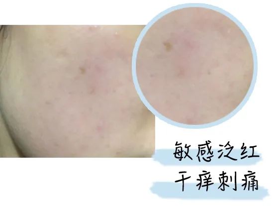 换季过敏烂脸爆皮用什么面膜,换季过敏脸上泛红长痘用什么面膜