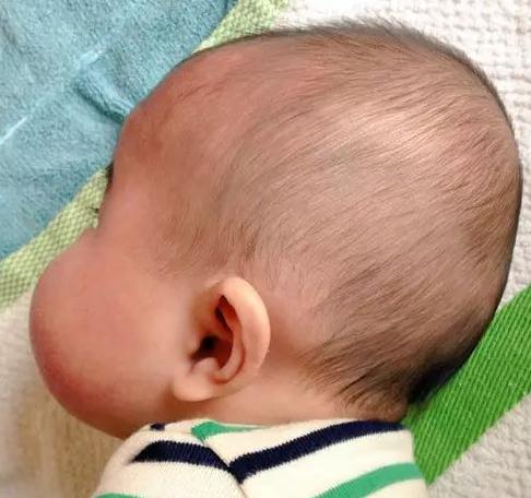 产钳夹伤宝宝医生有责任吗,婴儿产钳夹伤40天还没消正常吗