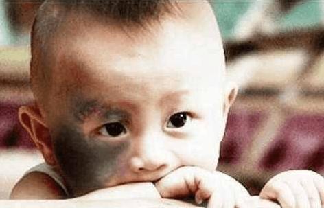 如何避免宝宝身上有胎记,宝宝有了胎记妈妈怎么办