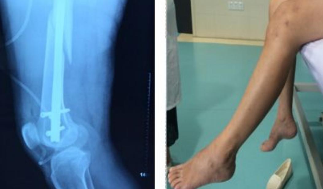 膝关节僵硬，活动受限咋办？中西医结合康复让关节重新“活”过来