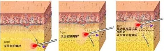 娃娃脸婴儿肥怎么瘦,怎么区分双下巴和婴儿肥