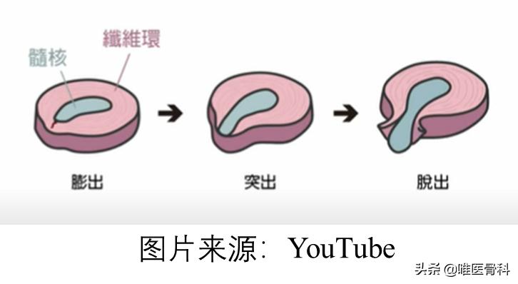 腰间盘膨出腿疼脚麻怎样治疗最好,腰间盘膨出腿麻腿疼怎么缓解
