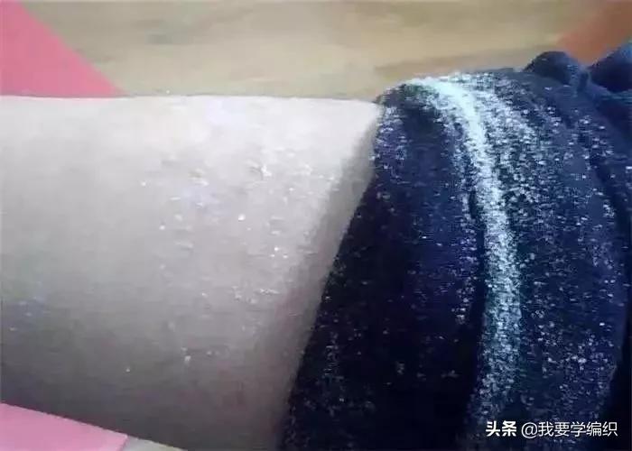 冬天干燥皮肤蛇皮,冬天冷皮肤粗糙