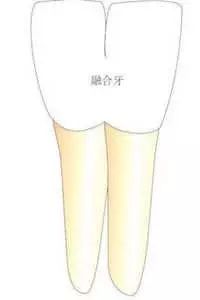 牙齿长成包谷牙怎么办,牙齿长成了双排牙如何矫正