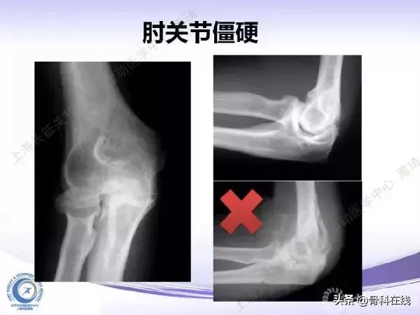 肘关节镜手术后引流,肘关节镜微创手术