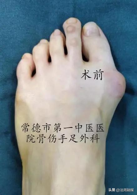 拇指长歪了?别慌!常德市第一中医医院专家帮您改“邪”归正