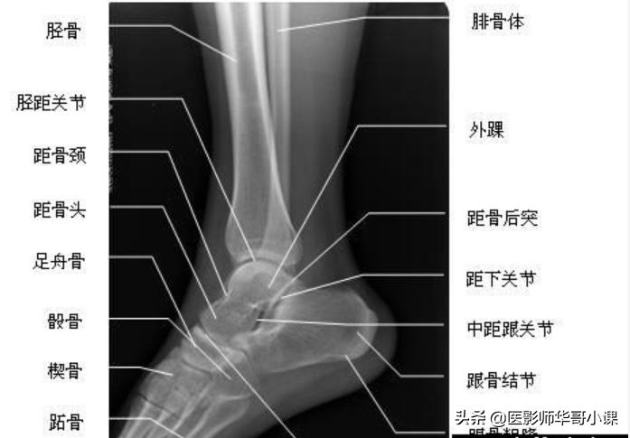 扭伤脚有必要去医院拍片吗,扭伤脚要去哪里看
