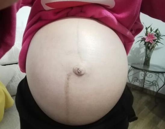 怀孕肚子上长毛变黑怎么回事,怀孕后肚子上长毛怎么回事