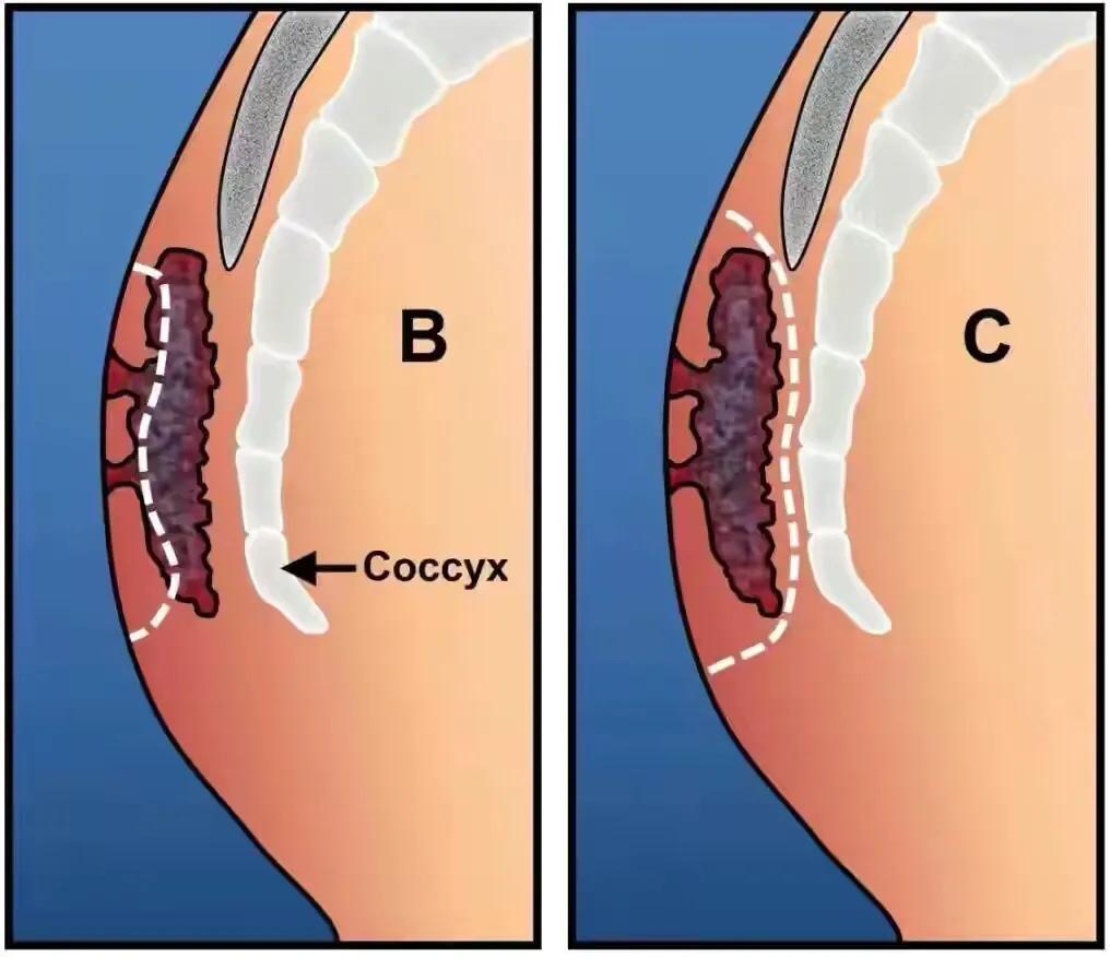 尾巴骨中间长痘痘特别疼,尾巴骨疼腿麻怎么回事