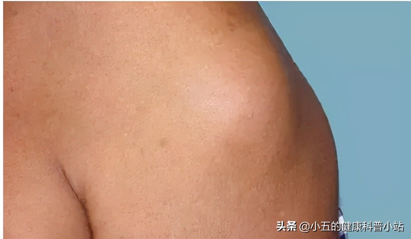 什么叫做脂肪瘤该怎么医治,脂肪瘤有什么危害脂肪瘤最怕什么