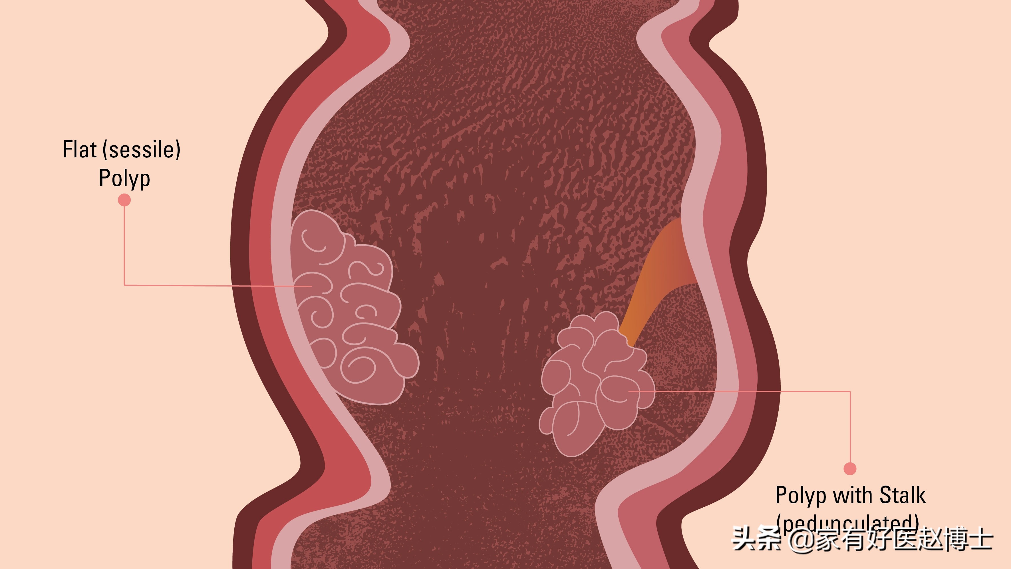 最常见5类息肉每个人都可能有，哪些无癌变风险，哪些需要切除？