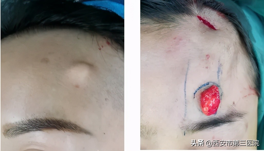 脂肪瘤的美容切除|解除七旬老人20年的困扰