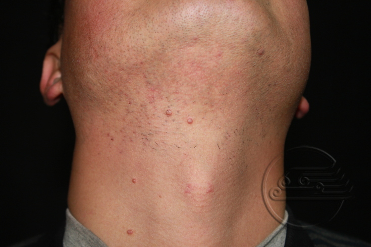 传染性软疣儿童怎么治可以断根,儿童脸上长了传染性软疣怎么办