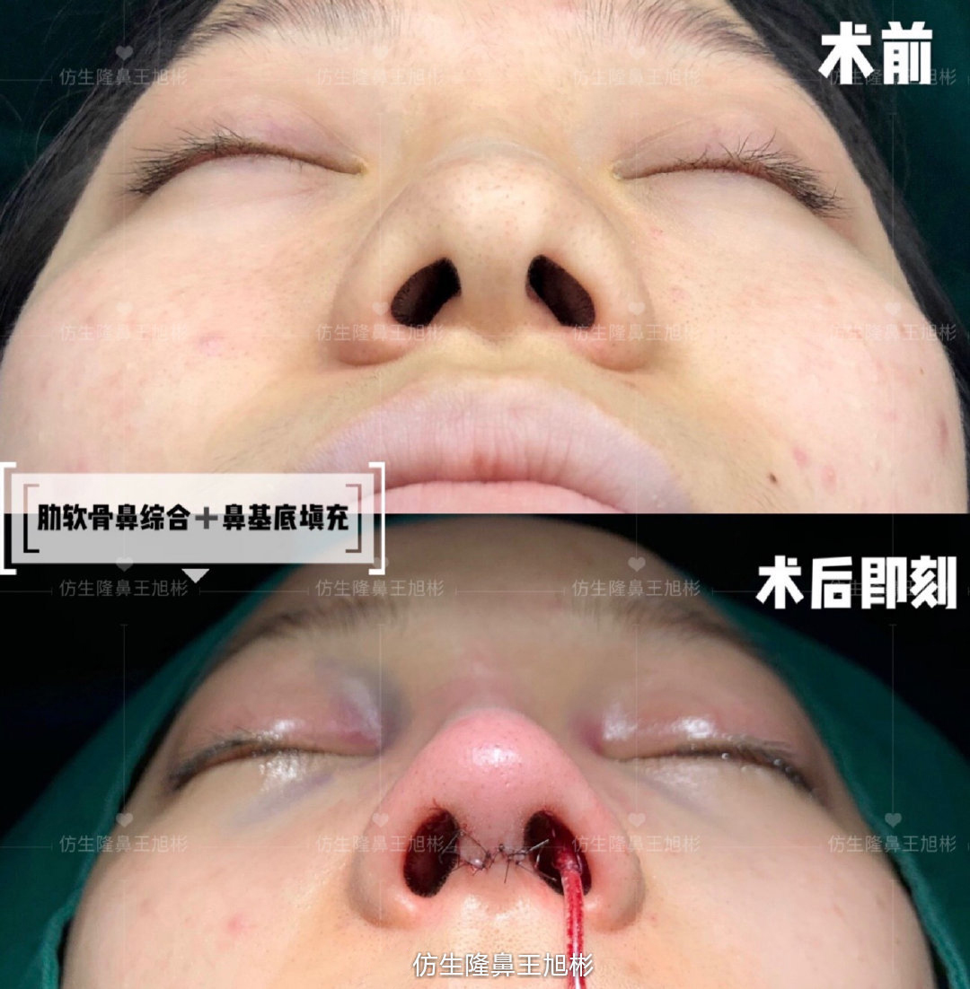 缩鼻翼可以改善鼻翼下垂吗,鼻翼肥大之鼻翼缩小术你见过吗