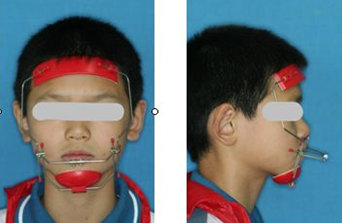 重庆哪个公立医院牙齿矫正比较好,反颌牙齿矫正多少钱