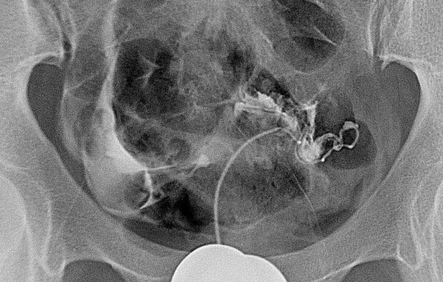 经常做介入对医生有影响吗,做了一次介入治疗不做了会怎样
