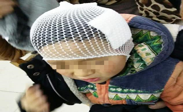 孩子摔倒后额头磕个大包怎么处理,女儿摔到脑袋