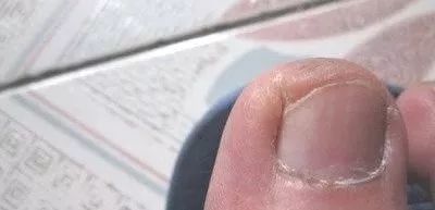 娃指甲上有白点是怎么回事,孩子指甲横纹有白点