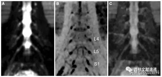 腰椎手术后神经根水肿要怎样治疗,腰椎融合术后神经根水肿吃中药