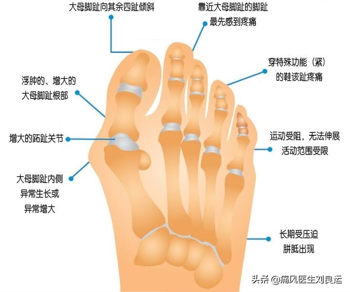 脚痛不知道是不是痛风,脚很痛不知道是痛风还是脚筋痛