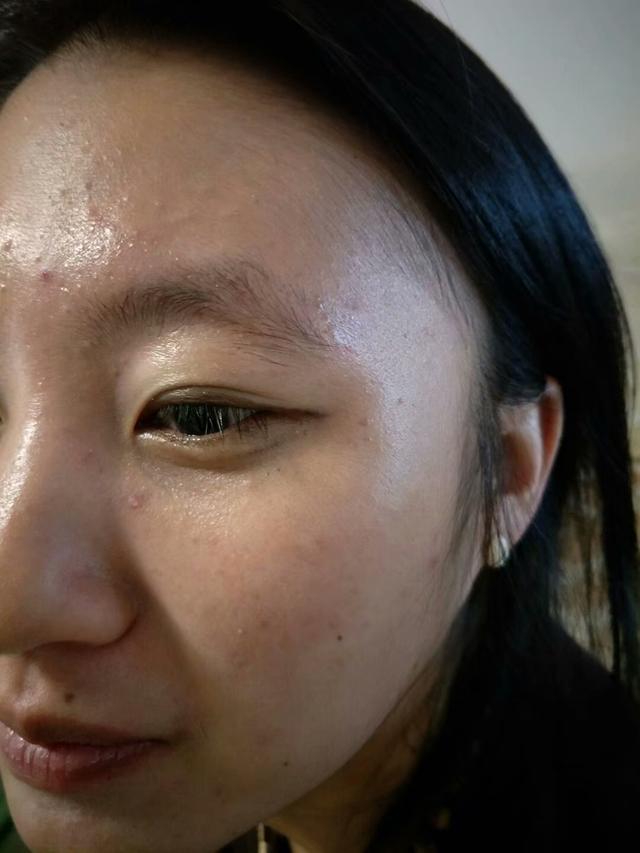 张家口祛痘印痘坑,张家口祛痘护理