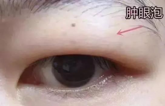 龚忠华整形,龚忠华双眼皮手术后多久恢复