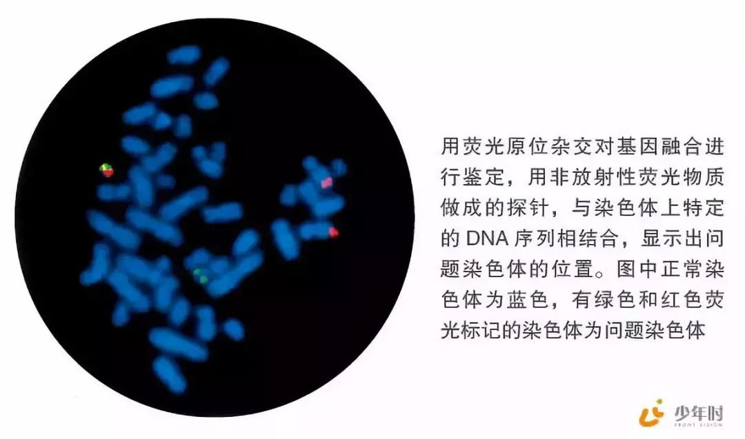 费城染色体形成原因,费城染色体会有什么影响