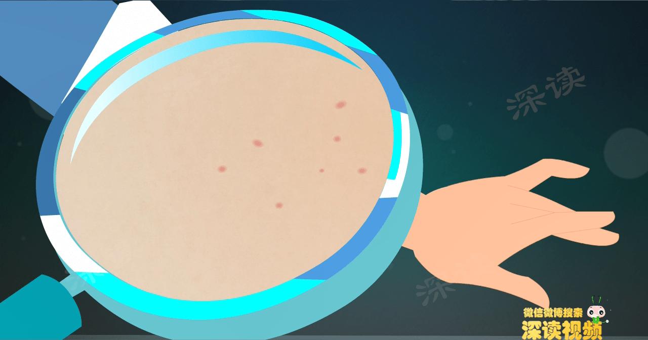 尖锐性湿疣都是hpv感染吗,尖锐性湿疣会引起hpv感染吗