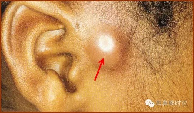 切除先天性瘘管要多久,先天性耳瘘管切除手术