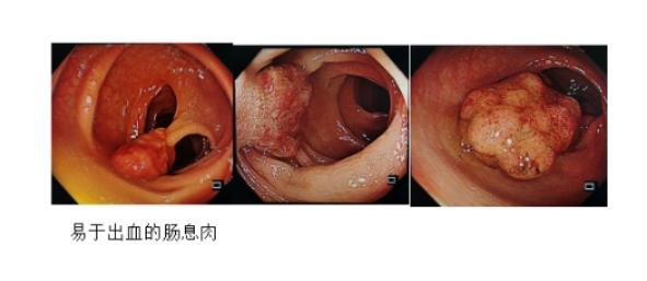 肠息肉切除夹子掉了会出血吗,肠息肉手术夹子脱落会出血吗