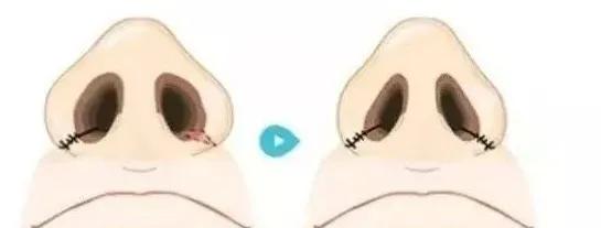 经常挖鼻孔导致鼻孔大怎么改善,酒糟鼻会导致鼻孔过大吗